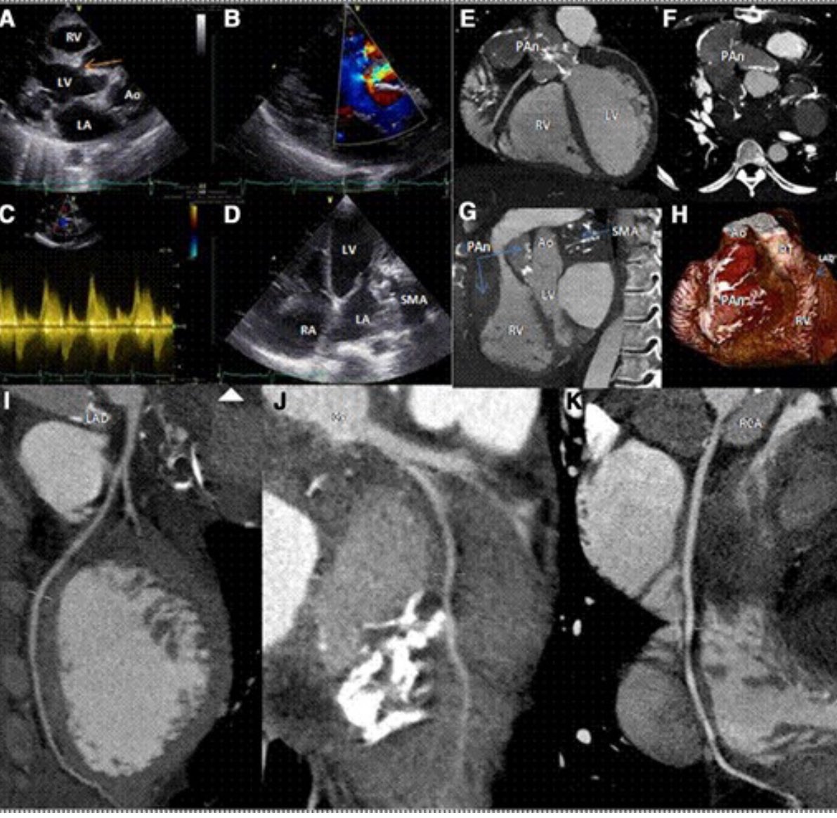 Huge pseudoaneurysm of the LVOT developed a few years after surgery for subvalvular mitral aneurysm: would you plug it ? 

Just published under #EHJIMP #ESCjournals

➡️ lnkd.in/d6A3K4XT
@alessia_gimelli @EHJIMPEiC @EACVIPresident @EZancanaroMD @ShehabAnwer @Sarah_Moharem…