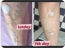 Christi10160212's tweet image. Tired of the 'ouch'? 🛑 There's a new patch in town turning 'OWs' into 'WOWs'! Got my hands on stem cell technology that kisses inflammation and pain goodbye. 🔬💥 PM for deets on this health game-changer. #PainRelief #StemCellMagic