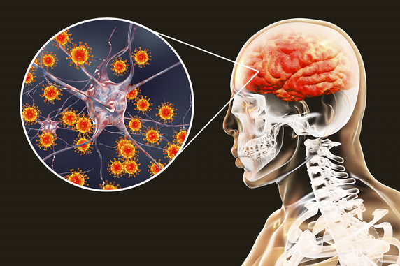 La_SRLF's tweet photo. #Reactu : Les infection neuroméningées vous donnent la migraine ?
Cette semaine la CERC de @La_SRLF vous propose deux réactus pour vous éclaircir les idées sur le sujet.
https://t.co/46e58bEQdU
#NeuroICU https://t.co/zpl6Bd4WIn