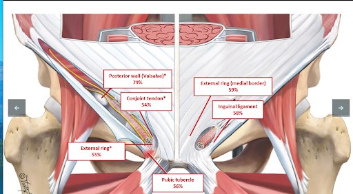 #BJSMBlog: Groin pain 🥴⚡️ PART 3️⃣

What is inguinal related groin pain and how do we diagnose it? 🧐

What tools can we use to monitor rehabilitation? 

Find out more HERE ➡️ bit.ly/4751UWo