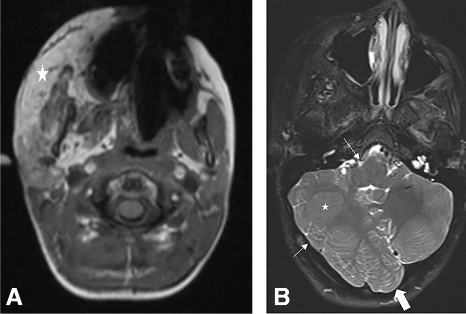 From the October-December 2023 Issue of #Neurographics: The Big Brain Theory: A Review of Overgrowth Syndromes for the Neuroradiologist ow.ly/YSGf50QvVuW