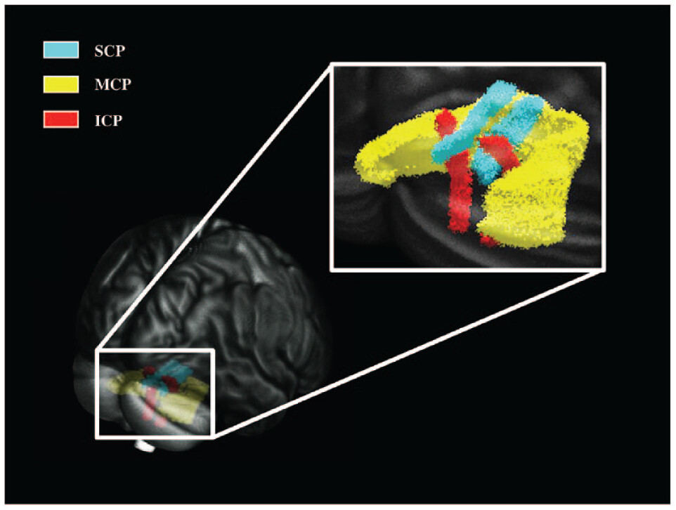 Abnormalities in the inferior cerebellar peduncle (ICP) maybe involved in the pathology of chronic ankle instability (#CAI). Further research in targeting this area maybe useful in the #diagnostic evaluation of this clinical entity.

Read it online now! ow.ly/tWgX50Qruau