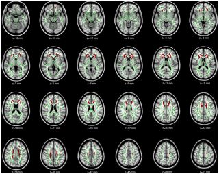 Gray matter atrophy

Grey matter is responsible for controlling movement, memory &amp; emotions.

A study scanned someone's brain addicted to phone usage &amp; found lower volume of grey matter with their brains resembling the physical shape &amp; size of drug users.

ncbi.nlm.nih.gov/pmc/articles/P…