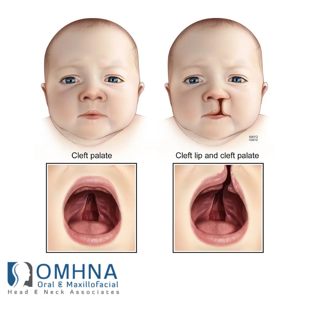 Craniofacial surgery is a specialized field that focuses on correcting and reconstructing deformities or conditions affecting the skull and face. This type of surgery is not just about enhancing appearance; it's crucial in aiding essential activities.  

#CraniofacialSurgery