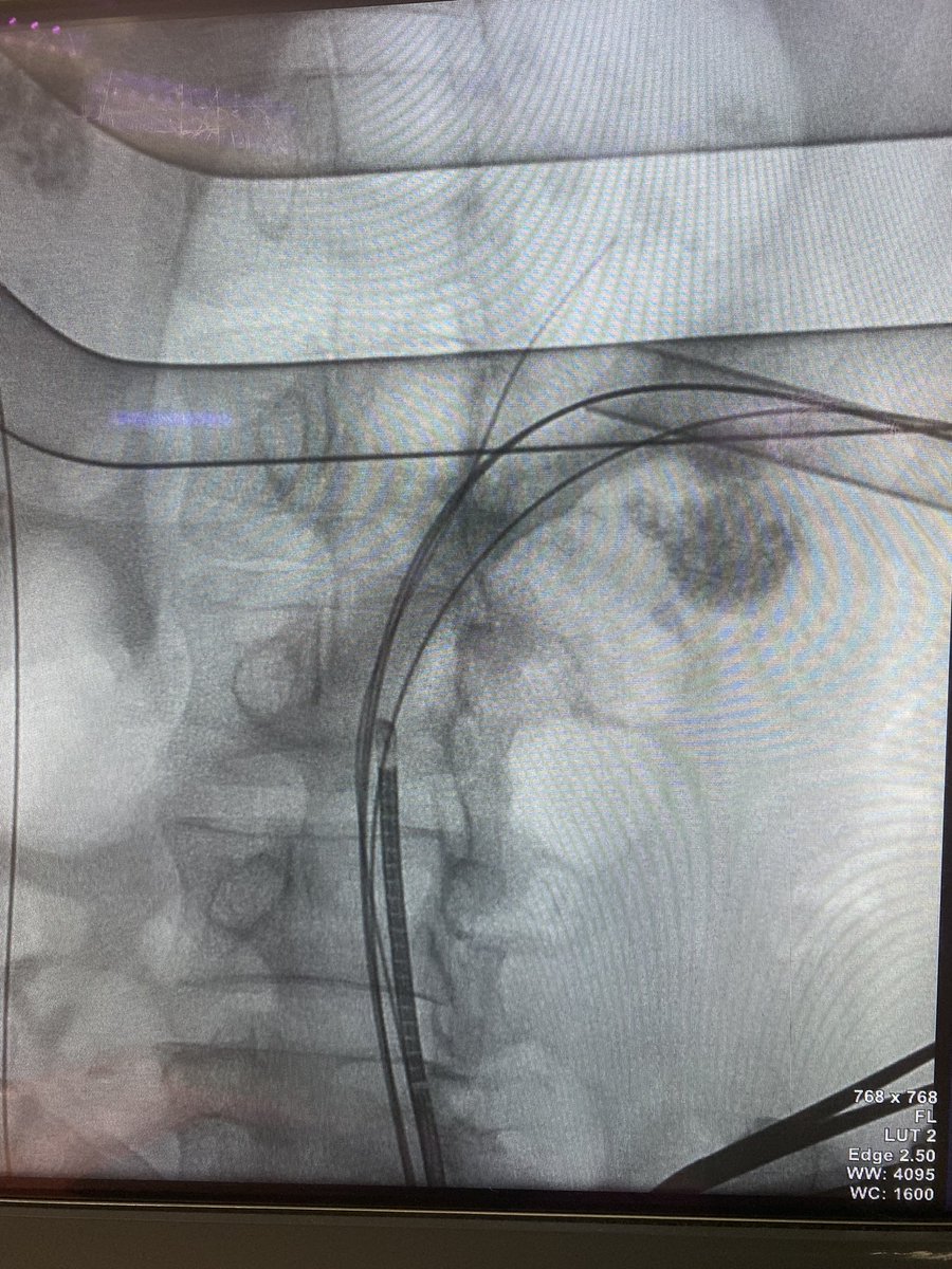 Have u ever seen a ureteral kinking like this ? Only after establishing a thru & thru wire it was possibile to get it straightened! Luckly enough my scope was a single use #lithovue! #ETCE