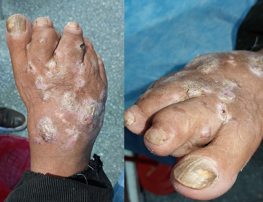 #NeglectedTropicalDiseases #WorldNTDsDay 30 Jan #Mycetoma
Knowledge about the signs and symptoms of mycetoma is essencial for an early diagnosis 
Delayed treatment can result in incapacitating sequelae. 
NODULES + FISTULAE + GRAINS = MYCETOMA
@CombatNTDs @MycetomaRC @DNDi