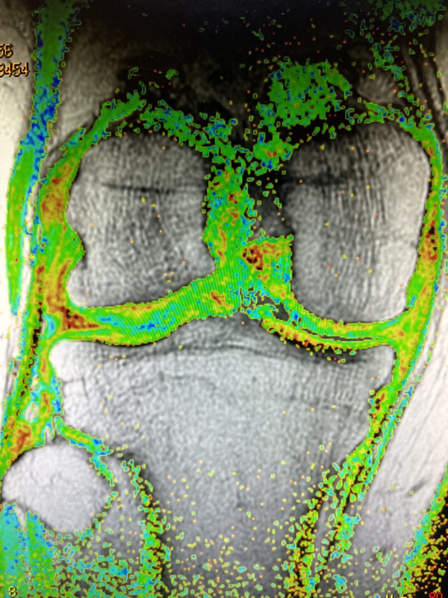 RegenOrthopod's tweet photo. What’s the rate limiting step for the development of knee arthritis? https://t.co/HWKI2zlBPe