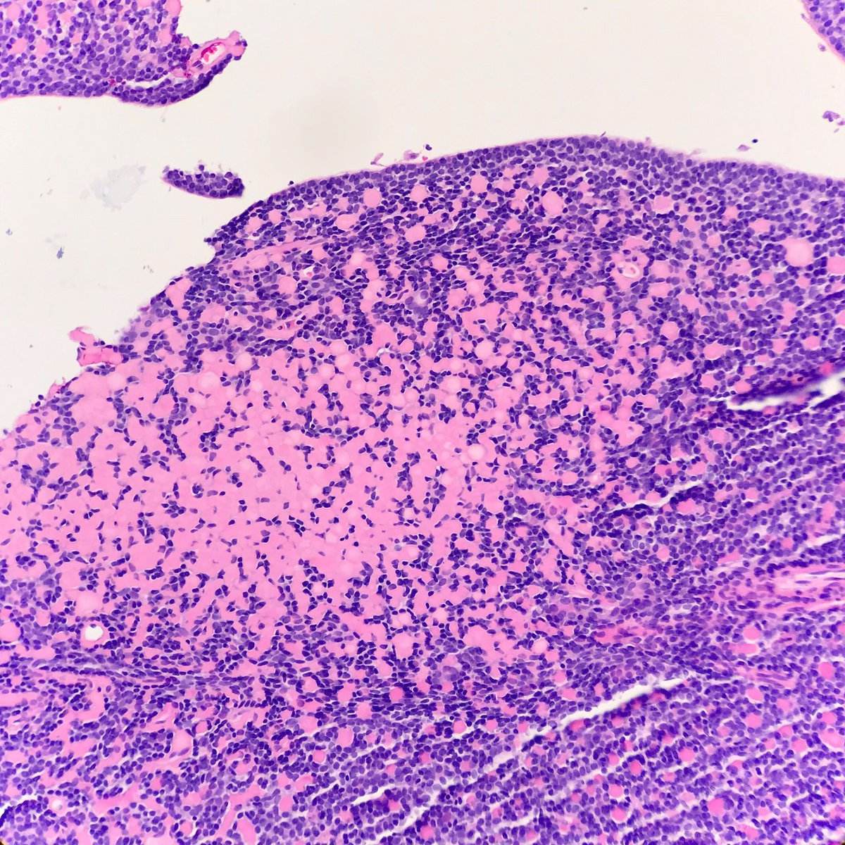 JMGardnerMD's tweet photo. Skin nodule. Your diagnosis? Answer: https://t.co/vsvn2ObI8Y. Video: https://t.co/CNhFmItr9Z #pathology #pathologists #pathTwitter #dermpath #dermatology #dermtwitter #dermatologia https://t.co/6x2vAe7RmP
