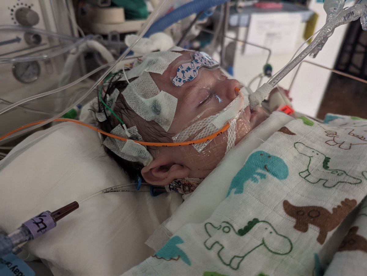 Hello, friends. Here is an update on our son, Gus: 

Yesterday was a long, hard day. Before noon, Gus had his chest closed (the sternotomy from his heart transplant) and the cannulas for ECMO moved to his neck. This was followed by a productive bronchoscopy that removed several