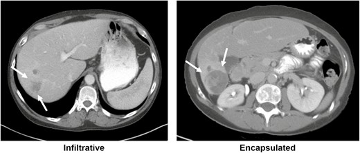 OncJournal's tweet image. Dr @HopSTranCao et al from @MDAndersonNews describe a scoring system (MDA CHOP) for #hpbcsm #HCC including radiographic, lab and patient characteristics with a prognostic significance comparable to CLIP, CTP, BCLC and others #GIonc @RussellGWitt doi.org/10.1093/oncolo…