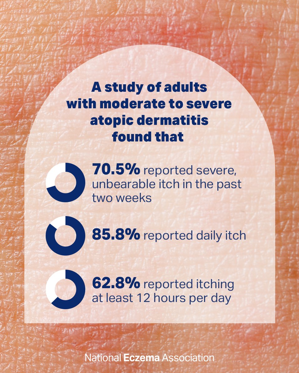 nationaleczema's tweet photo. Itch is the most burdensome and common symptom of #atopicdermatitis. 
⁠
Learn more about #eczema's #itch: https://t.co/HA9wcItfQK

#eczemaresearch #research #eczemaitches #eczematreatment #GetEczemaWise https://t.co/EKt9VrSpXZ