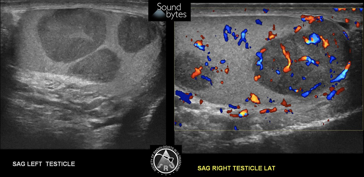 Answer to last week's case: Leukemic involvement of bilateral testicles. 

Note multiple bilat well-circumscribed, hypoechoic testicular masses with assoc vascularity. 

Case Courtesy of Dr's Aparna Singh and Yang Guo; Brigham and Women's Hospital
#ultrasound #RadRes <a href="/YangGuo_Rad/">Yang Guo</a>