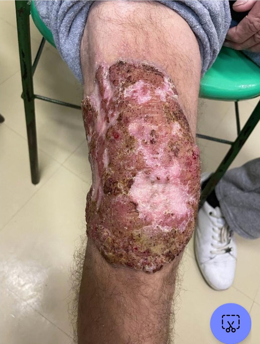 Today is #WorldNTDDay
Among #NTD,  Chromoblastomycosis is a devastating skin disease that can lead to stigma and disability.
Today, at the Mycology outpatient clinic at HC-UFPR, our Mycology Team, headed by Prof. Flávio Telles, evaluated a patient with extensive CBM, as follows