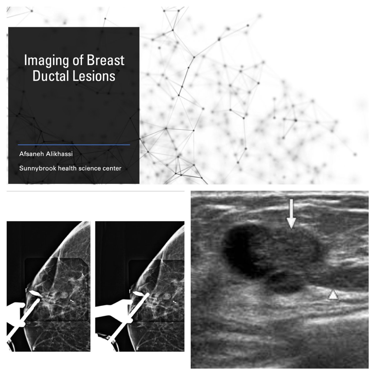 A_Alikhassi's tweet photo. Had a fun time in the first 2024 Breast Imaging City-wide Rounds today, presenting Breast Ductal lesions Imaging! 
Thank you @SupriyaKulk our divisional lead @UofTMedIm https://t.co/Nl9VgLxUZw
