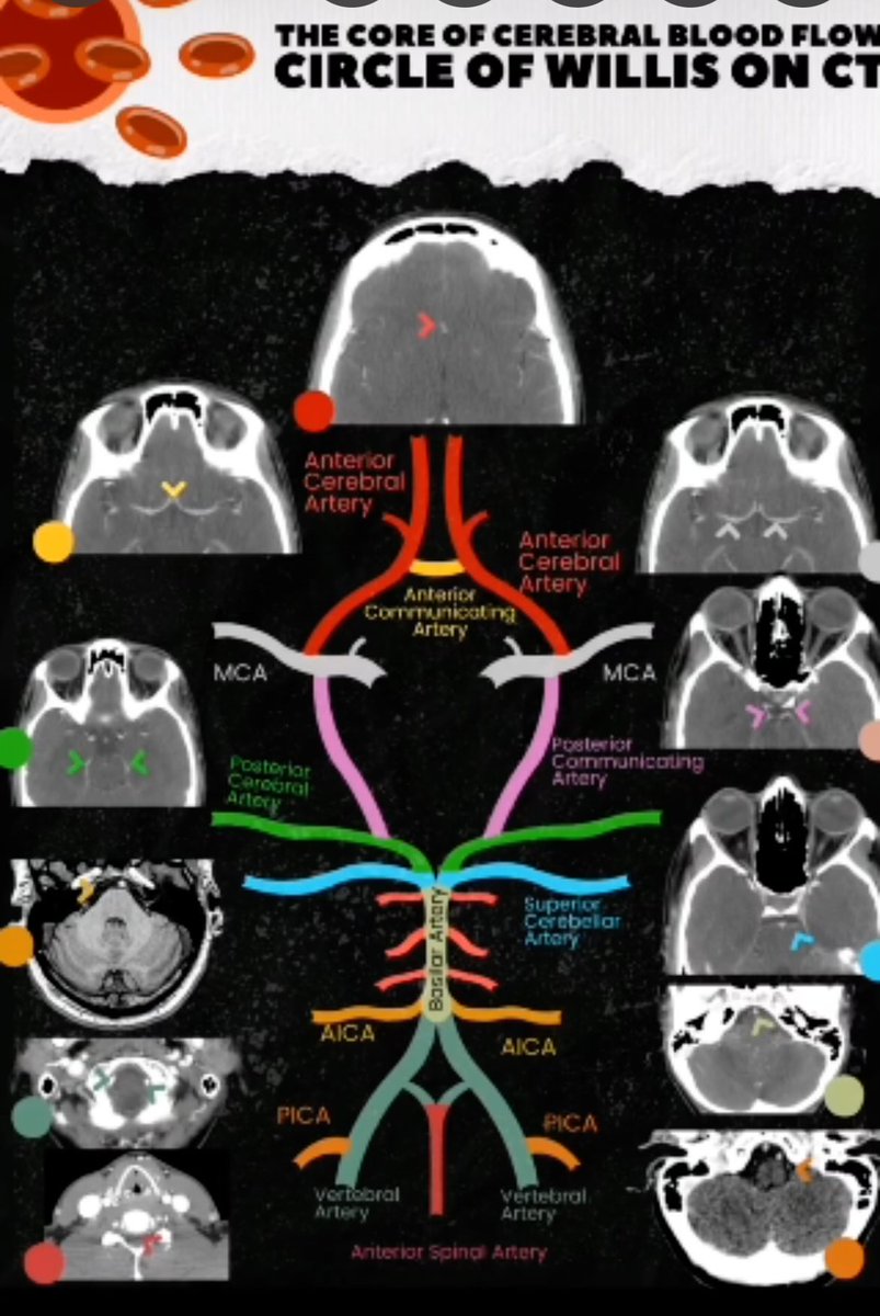 Circle of Willis on CTA