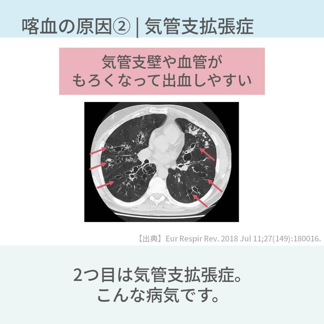 PulmoSheep's tweet photo. 喀血の原因5選
↓
続き https://t.co/RlYvxTwEq3