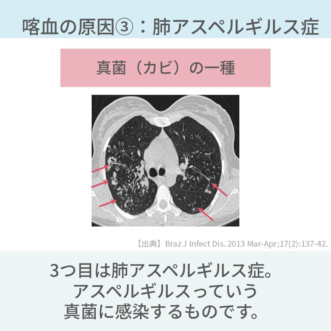 PulmoSheep's tweet photo. 喀血の原因5選
↓
続き https://t.co/RlYvxTwEq3