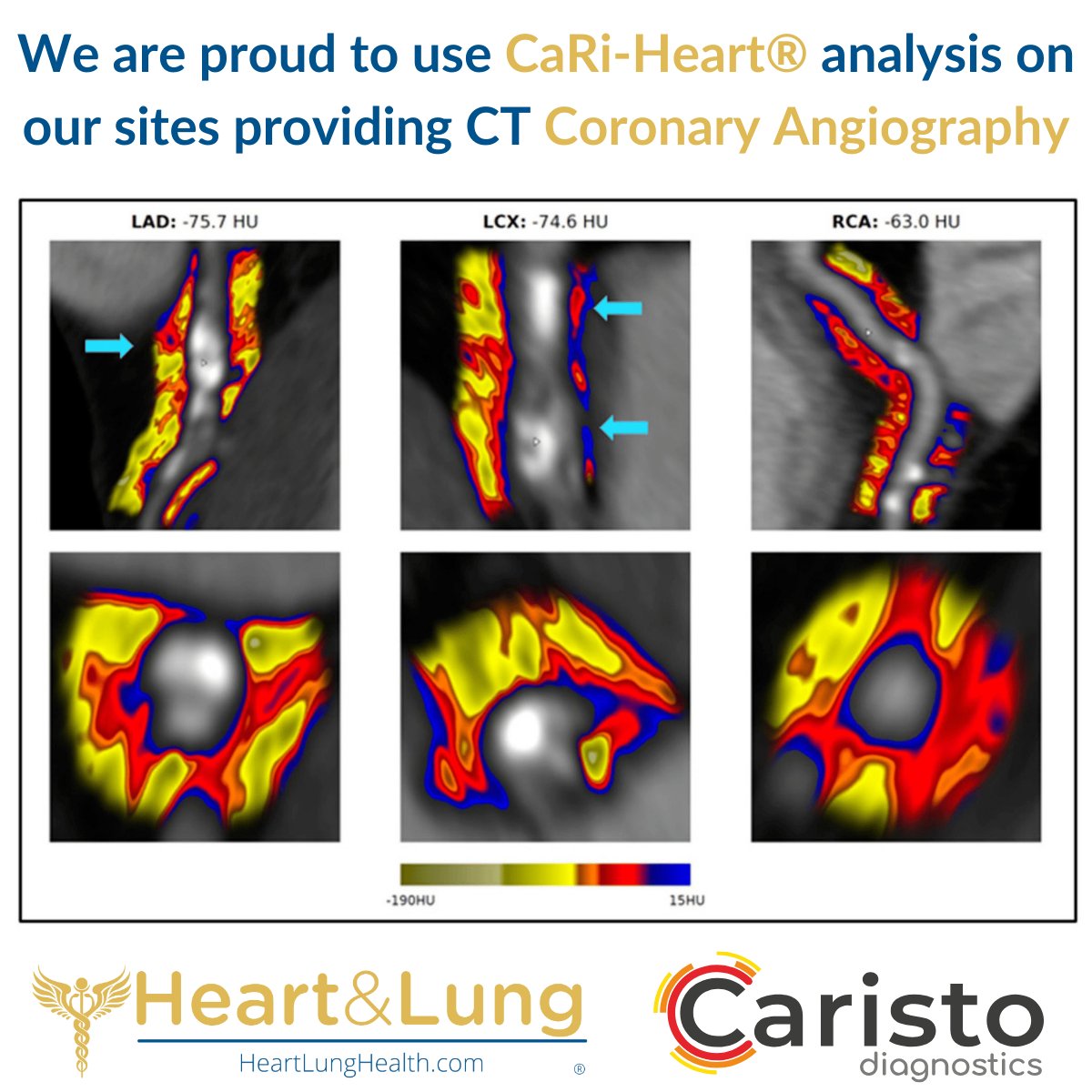 We are proud to be integrated with @CaristoHeart on our sites providing CT coronary angiography.

CaRi-Heart® analysis is a non-invasive #predictiveAI technology, providing individualised risk of fatal heart attack over 8 years.

Email info@heartlunghealth.com for more details 🫀