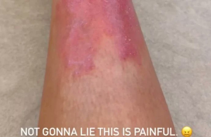BANGShowbiz's tweet image. bangpremier.com/story/8/300196…
Kim Kardashian has tried "everything" to deal with a "painful" bout of psoriasis
Do you have any tips for her?
#BANGPremier #KimKardashian #SKKM #psoriasis