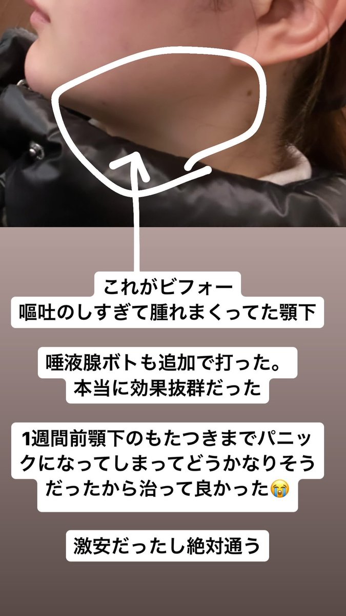 eccentricbambi's tweet photo. 広頚筋ボトックスと唾液腺ボトックスについて https://t.co/EahdFOsN4i