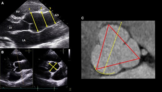 How to measure the aorta? Check the ideal answer from here: academic.oup.com/ehjcimaging/ar… Follow us for more educational posts on Echocardiography. Enhance your knowledge and stay updated with the latest practices. #EACVI #Echocardiography #CardiovascularImaging #KnowYourGuidelines