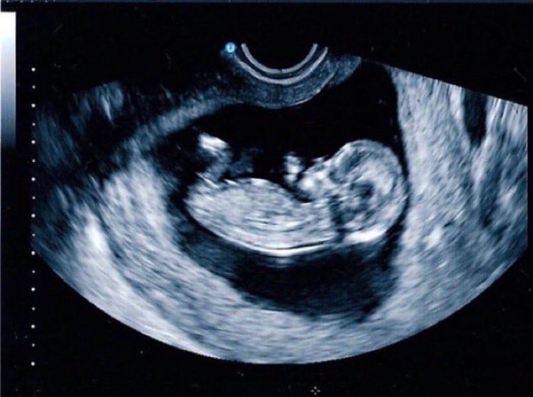 porlavida2014's tweet photo. ¿Sabías que a las 10 semanas esta niña ya está completamente formada y que la mayoría de #aborto son en esta semana? #SiAlaVida https://t.co/4XviD1vDag