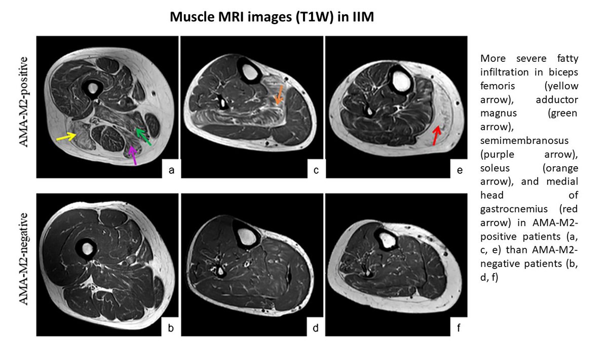 ✅Severe fatty infiltrations in the posterior muscles of the lower extremities are dominant MRI features in AMA-M2-positive #IIM #inflammatorymyopathy ✅This unique muscle MRI feature may be very helpful for diagnosing the AMA-M2-positive IIM. 👉rdcu.be/dxpKT