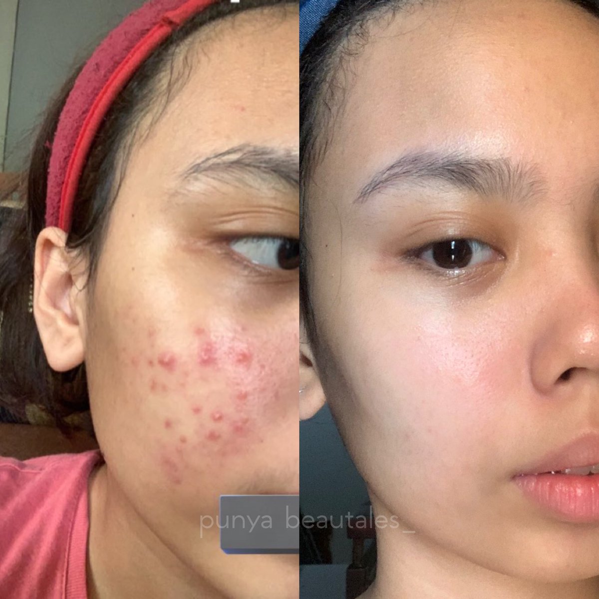 “cobain skincare korea deh, bagus bagus trs abisnya lama 💯”

ASLIIIIII, aku mau salim sama si cosrx ini karena ini salah satu skincare yang bikin skin barrier aku sembuh…

habisnya baru setelah 6-8 bulanan.. 😀🫵