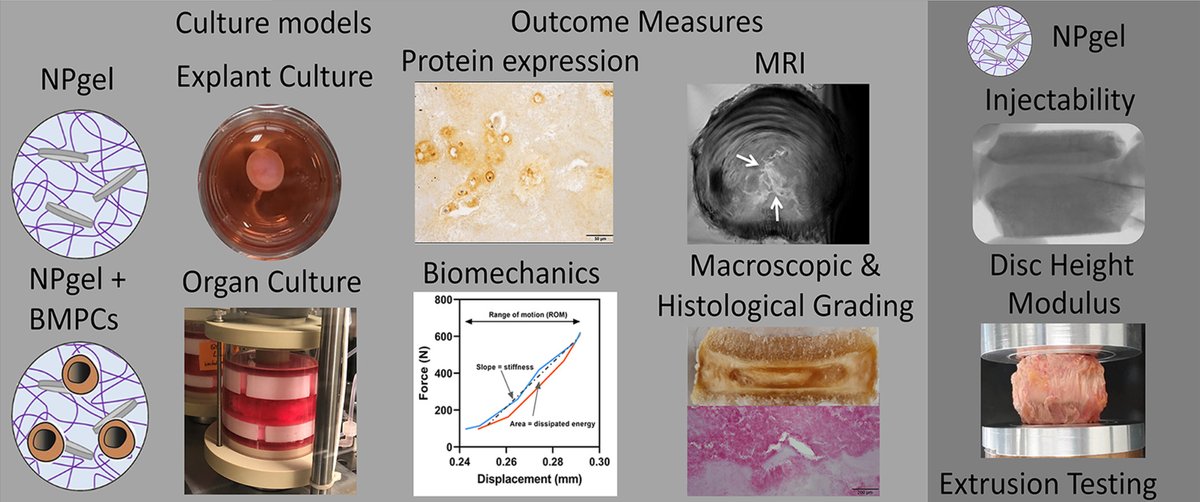 Acta Biomaterialia (@actabio) on Twitter photo Professor Christine L. Le Maitre: Injectable hydrogel induces regeneration of naturally degenerate human intervertebral discs in a loaded organ culture model <a href="/ProfLeMaitreIVD/">Prof. C. Le Maitre</a> <a href="/ShrinersCanada/">Shriners Hospitals for Children Canada</a> @McGillBME <a href="/McGillDeptSurg/">McGill Dept of Surg</a> <a href="/sheffielduni/">The University of Sheffield</a> <a href="/sheffhallamuni/">Sheffield Hallam University</a> sciencedirect.com/science/articl… Professor Christine L. Le Maitre: Injectable hydrogel induces regeneration of naturally degenerate human intervertebral discs in a loaded organ culture model <a href="/ProfLeMaitreIVD/">Prof. C. Le Maitre</a> <a href="/ShrinersCanada/">Shriners Hospitals for Children Canada</a> @McGillBME <a href="/McGillDeptSurg/">McGill Dept of Surg</a> <a href="/sheffielduni/">The University of Sheffield</a> <a href="/sheffhallamuni/">Sheffield Hallam University</a> sciencedirect.com/science/articl…