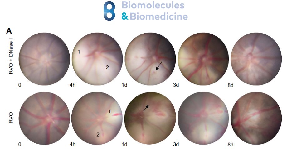 Discover how DNase I acts as a guardian against Retinal Vein Occlusion, a major cause of vision loss. 

Read the Author Summary here: 
🔗blog.bjbms.org/the-protective…

#biomoleculesandbiomedicine #retinalveinocclusion #Dnase #eyeresearch