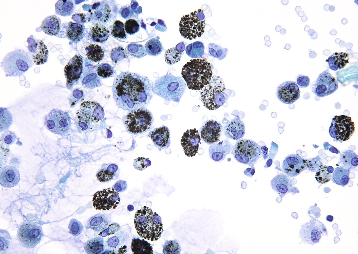 sza_jhcyto's tweet photo. Smoker’s Lung on a bronchoalveolar lavage. https://t.co/vHIYV5NkYG
