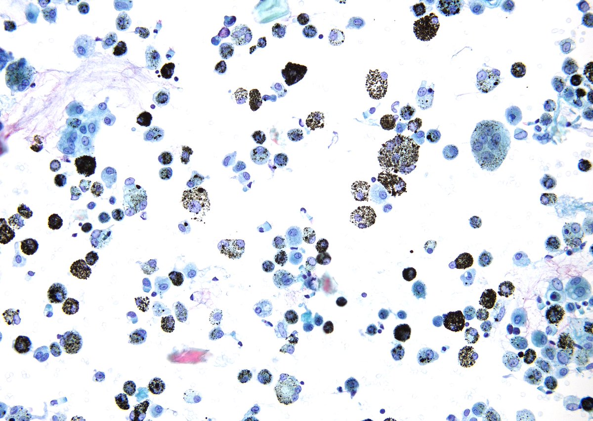 sza_jhcyto's tweet photo. Smoker’s Lung on a bronchoalveolar lavage. https://t.co/vHIYV5NkYG