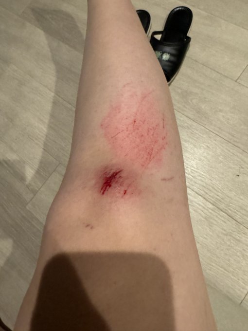 コケた😭傷まみれ🩹 https://t.co/BwD78FT4g1