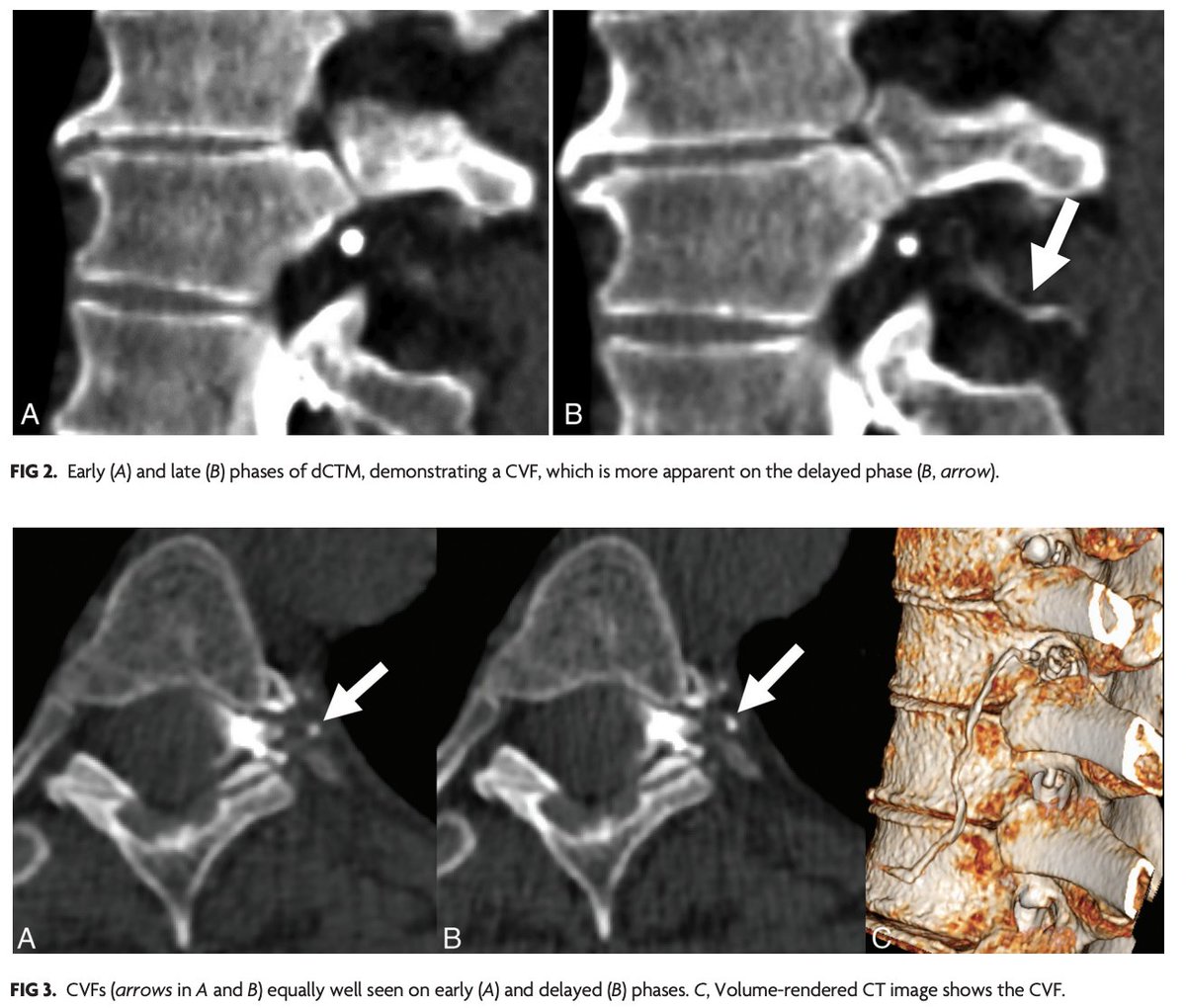 AJNR (@theajnr) on Twitter photo "Temporal Characteristics of CSF-Venous Fistulas on Dynamic Decubitus CT Myelography: A Retrospective Multi-Institution Cohort Study"
doi.org/10.3174/ajnr.A…
#CSFLeak #EditorsChoice
<a href="/AndrewCallenMD/">Andrew L Callen MD</a> <a href="/Mohamfakhr/">Mo Fakhri</a> <a href="/VincentTimpone/">Vincent Timpone</a> <a href="/AsheshThaker/">Ashesh Thaker</a> <a href="/williamdillonmd/">William Dillon, M.D.</a> <a href="/vinil_shah/">Vinil Shah</a> "Temporal Characteristics of CSF-Venous Fistulas on Dynamic Decubitus CT Myelography: A Retrospective Multi-Institution Cohort Study"
doi.org/10.3174/ajnr.A…
#CSFLeak #EditorsChoice
<a href="/AndrewCallenMD/">Andrew L Callen MD</a> <a href="/Mohamfakhr/">Mo Fakhri</a> <a href="/VincentTimpone/">Vincent Timpone</a> <a href="/AsheshThaker/">Ashesh Thaker</a> <a href="/williamdillonmd/">William Dillon, M.D.</a> <a href="/vinil_shah/">Vinil Shah</a>