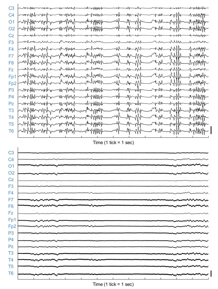 Journal of Clinical Neurophysiology (@jclinneurophys) on Twitter photo Authors Qing et al examine the effects of #ketamine using #EEG in patients who experience #cardiacarrest and subsequent #seizures. Article available at: bit.ly/47LZvzo <a href="/WCMCNeurology/">Weill Cornell Neurology</a> <a href="/UMiamiNeuro/">UMiami Neurology</a> <a href="/ColumbiaNCC/">Columbia NeuroCriticalCare</a> <a href="/ACNS_org/">ACNS</a> Authors Qing et al examine the effects of #ketamine using #EEG in patients who experience #cardiacarrest and subsequent #seizures. Article available at: bit.ly/47LZvzo <a href="/WCMCNeurology/">Weill Cornell Neurology</a> <a href="/UMiamiNeuro/">UMiami Neurology</a> <a href="/ColumbiaNCC/">Columbia NeuroCriticalCare</a> <a href="/ACNS_org/">ACNS</a>