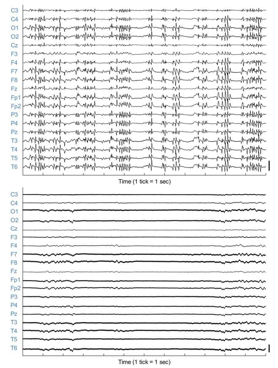 Authors Qing et al examine the effects of #ketamine using #EEG in patients who experience #cardiacarrest and subsequent #seizures. Article available at: bit.ly/47LZvzo @WCMCNeurology @UMiamiNeuro @ColumbiaNCC @ACNS_org