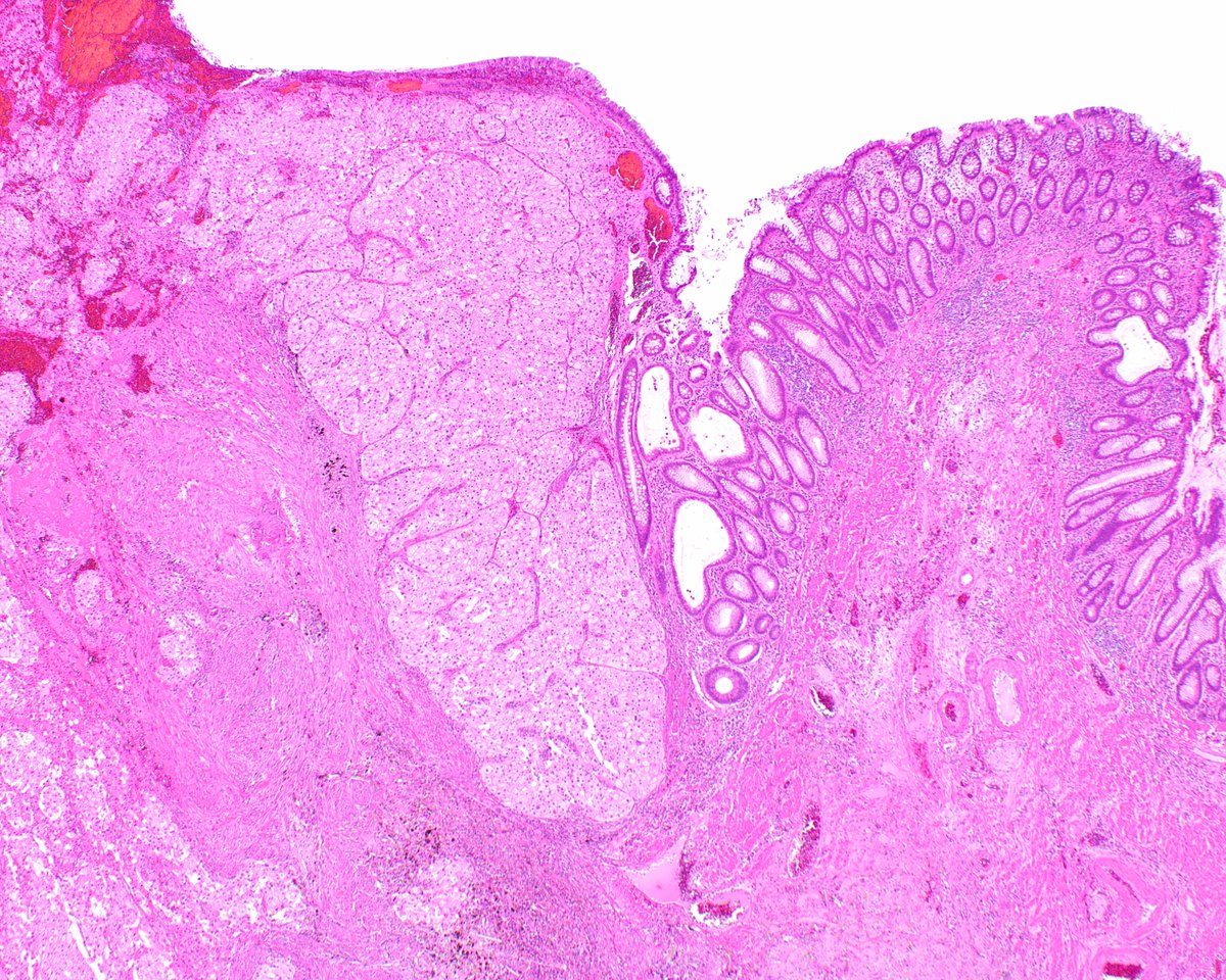 LizMontgomeryMD's tweet photo. Chromophobe renal cell carcinoma has spread to the colon.  Many immunohistochemical stains would have been wasted without history! #UMiamiPath https://t.co/wlw7asjjTV