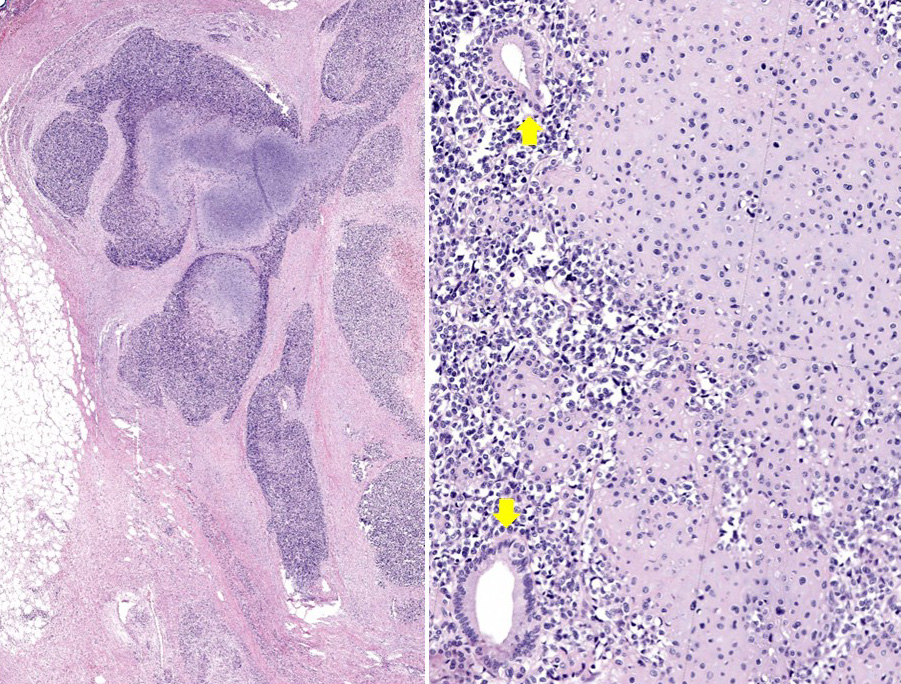 Life &amp; #pathology are full of surprises. An unexpected guest in #pancreas. A biphasic malignant neoplasm with 2 components: 1) sheets of small blue round cells with⬆️increased mitotic activity. 2) #cartilaginous component. CD99/BCL2 (+).
Diagnosis: #Mesenchymal #Chondrosarcoma