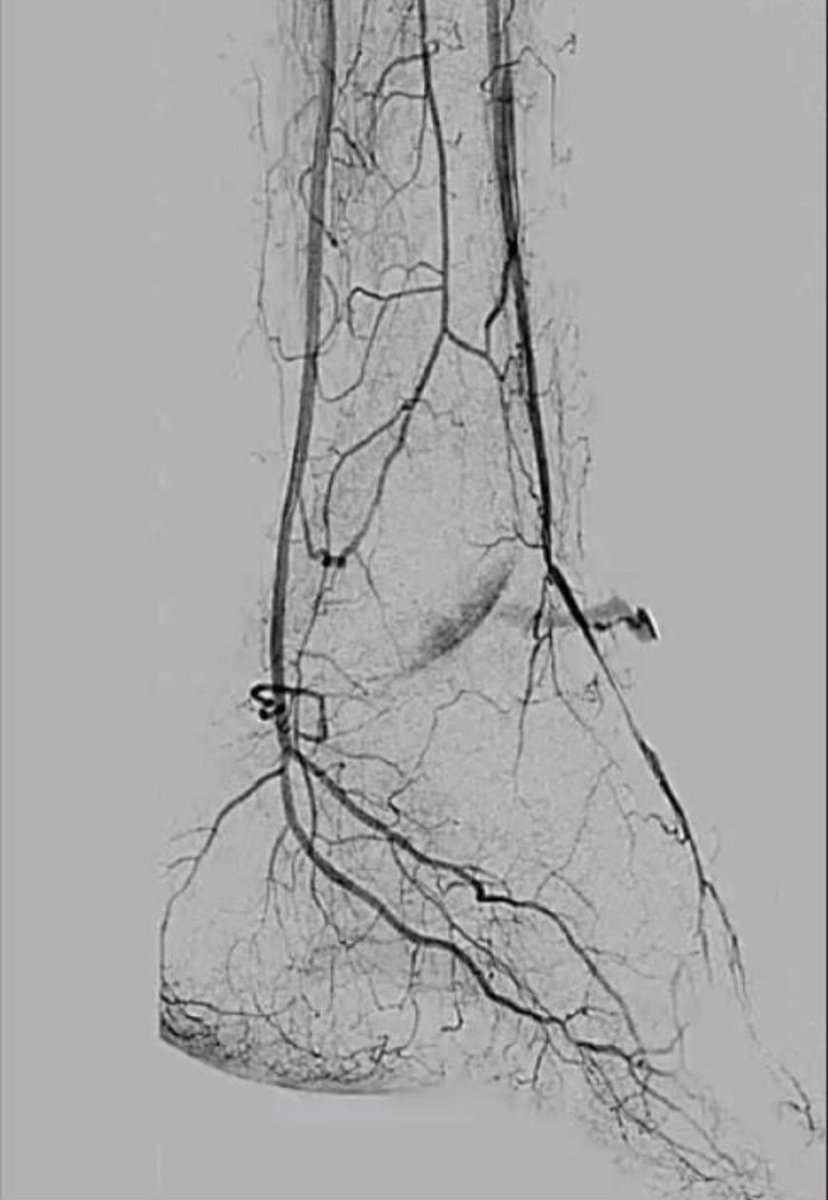 Planning a better future for patients with chronic limb-threatening ischaemia globally: A Special Commission on chronic limb threatening ischaemia @BEST_CLI @bjsurgery. academic.oup.com/bjs/article/11…