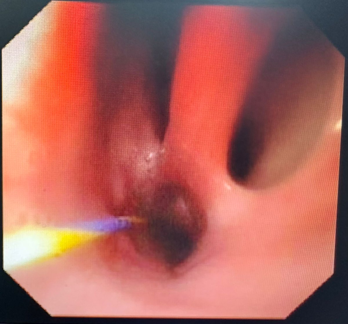GNTPak's tweet photo. Post head injury, prolonged Intubation and TE fistulae formation; 15 cm owl’s eye two TE fistula and a single fistula at 20 cm. Guide wire is in the esophageal lumen; Surgery or Some endoscopic trick https://t.co/NHIEtu6bR3