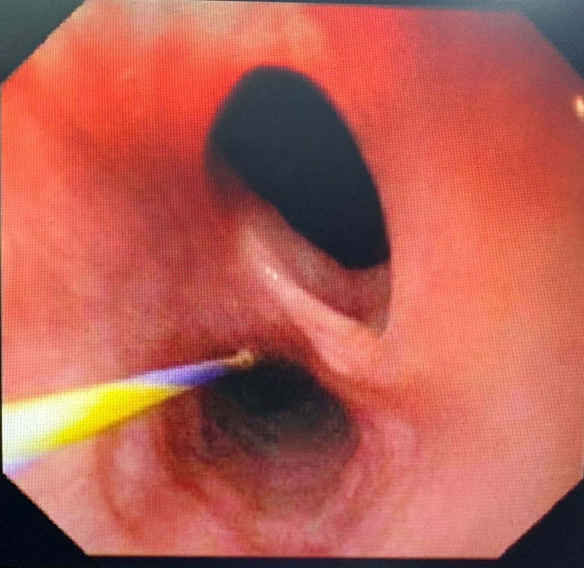 GNTPak's tweet photo. Post head injury, prolonged Intubation and TE fistulae formation; 15 cm owl’s eye two TE fistula and a single fistula at 20 cm. Guide wire is in the esophageal lumen; Surgery or Some endoscopic trick https://t.co/NHIEtu6bR3