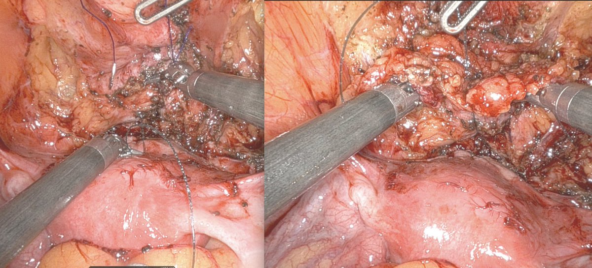 Brian J. Flynn, M.D. (@brian_j_flynn) on Twitter photo My N = 4
Have you seen this?
22 yo referred from OSH w total incontinence after C-section with bladder injury
Diagnosis- Vesico-Uterine Fistula
Solution - Robotic fistula repair (CU FRU) uterine preservation (CU Minimally invasive GYN
@JaimeArruda)
<a href="/CU_Urology/">CU Urology</a>
<a href="/RohanBhallaMD/">Rohan Bhalla</a> My N = 4
Have you seen this?
22 yo referred from OSH w total incontinence after C-section with bladder injury
Diagnosis- Vesico-Uterine Fistula
Solution - Robotic fistula repair (CU FRU) uterine preservation (CU Minimally invasive GYN
@JaimeArruda)
<a href="/CU_Urology/">CU Urology</a>
<a href="/RohanBhallaMD/">Rohan Bhalla</a>