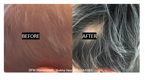 dfwhomeopath's tweet photo. Homeopathy helped one more kid who lost his hairs suddenly .😀 https://t.co/7qaN357yaF