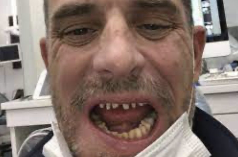 OrientPilgrim's tweet image. I also know a guy, he snorted #Cocaine and #Crack and after 10 years he had no teeth anymore. Crazy!