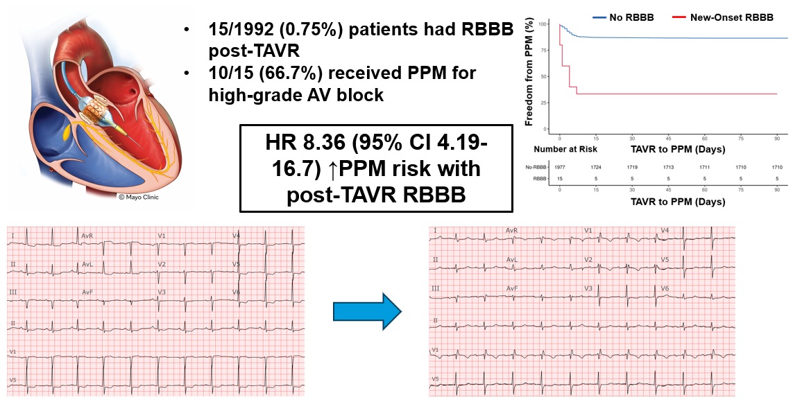 In a study of 1992 TAVR patients, 15 (0.75%) developed RBBB post-TAVR, of whom 10 (66.7%) needed PPM for high-grade AV block. Post-TAVR RBBB had ↑8.36x PPM risk vs no-RBBB #AHAJournals #Epeeps doi.org/10.1161/CIRCEP…