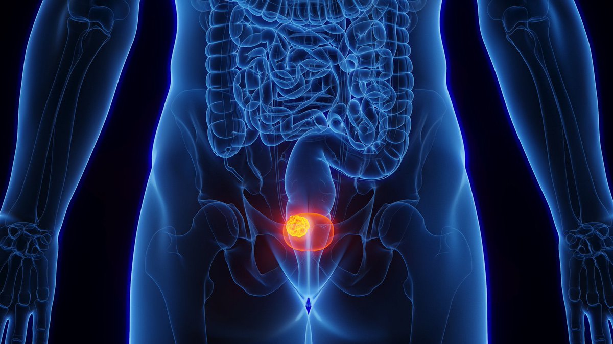 Artikel über die Identifizierung zuverlässiger #Biomarker zur Früherkennung von #Harnblasenkrebs. Veröffentlicht von Forschenden des #IPA, des <a href="/ProteomCenter/">Medizinisches Proteom-Center</a> und der Klinik für Urologie am Marien-Hospital Herne, Universitätsklinikum der <a href="/ruhrunibochum/">Ruhr-Universität Bochum</a>: mdpi.com/1422-0067/25/2…