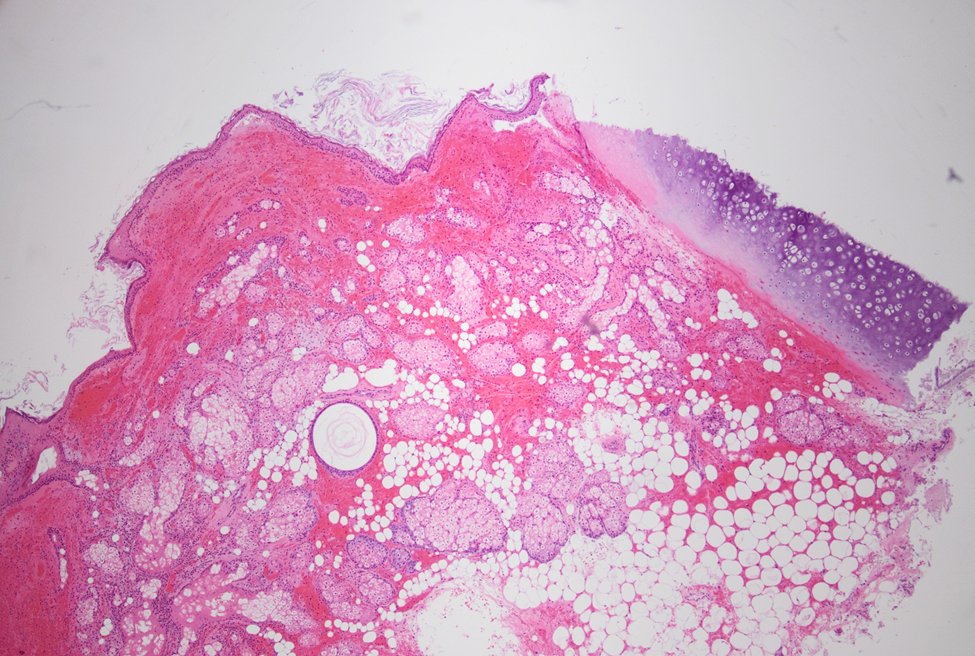 MhPathology's tweet image. 40-year-old woman with adnexal mass
Mature cystic teratoma #Medpath #PathTwitter