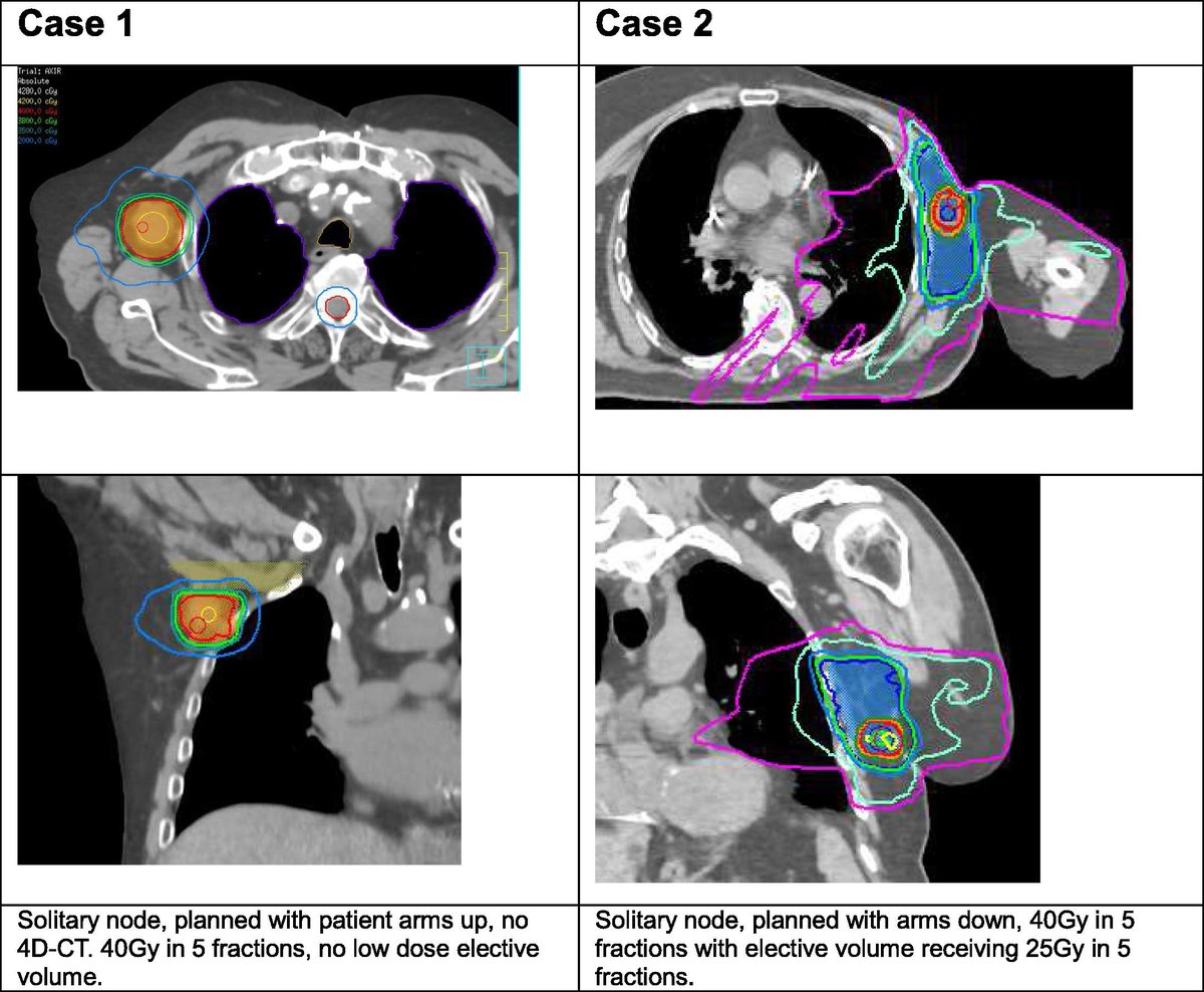 Uncovering the armpit of SBRT - in this 🌎's first case series reported from @Sunnybrook - we describe our teams experience for the unique target of axillary 🦾metastases #radonc ☢️⚡️ ctro.science/article/S2405-…