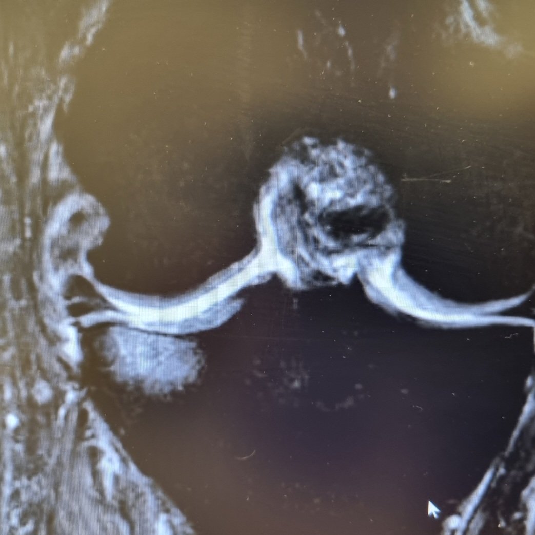 With consent. Chronic tear lateral meniscus, lateral compartment OA. Lateral sided symptoms only. Tender JL, pain deep flex/meniscus provocation. Pain from lateral meniscus, subchondral bone oedema, both? USS nicely shows abnormal appearance on the LM. #mskus