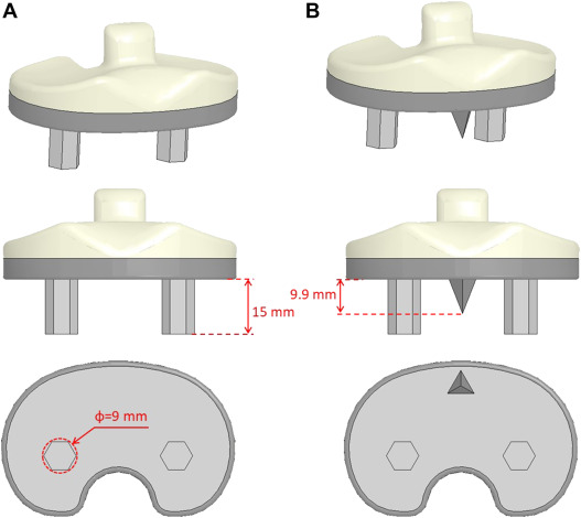 An anteriorly placed spike for cementless tibial baseplates with 2 pegs can help decrease the bone-implant micromotion during stair ascent, especially for subjects with increased bone-implant micromotion and risk for bone ingrowth failure.

authors.elsevier.com/a/1iHJK38vD36G…